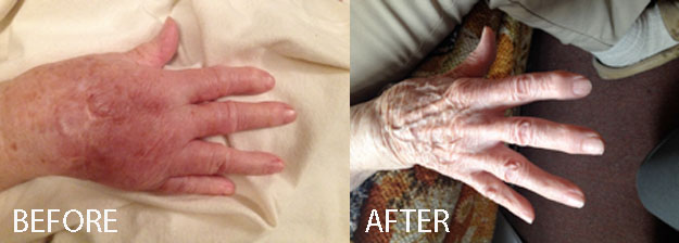 Lymphedema Hands